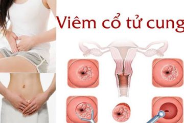 Viêm cổ tử cung nhẹ có tự khỏi không? Cách chữa trị triệt để