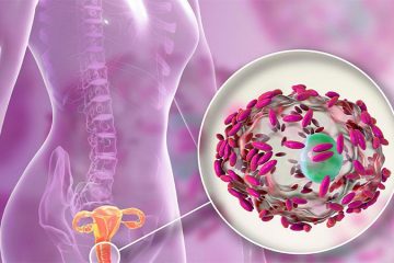 Mọi điều bạn cần biết về viêm âm đạo do vi khuẩn (BV)