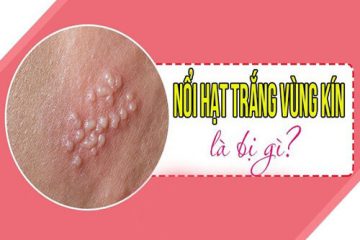 Nổi đốm trắng ở vùng kín nữ nguyên nhân do đâu, cách điều trị