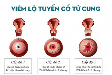 Viêm lộ tuyến cấp độ nào nguy hiểm nhất? Cách điều trị ra sao?